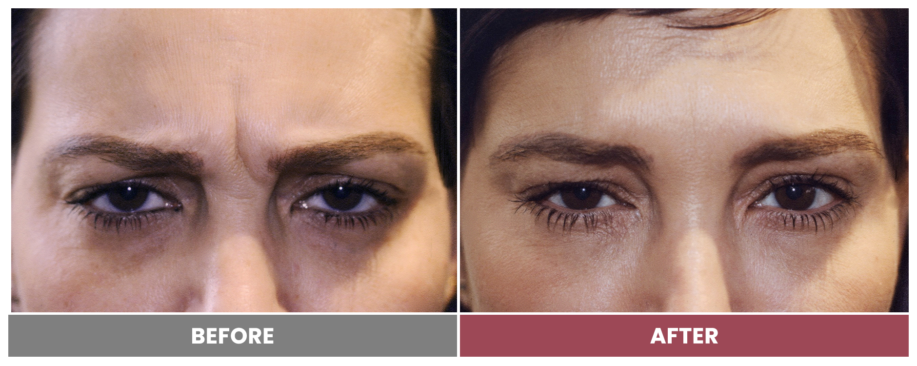 BOTOX FOR WRINKLES & BROW LIFT - Case 12